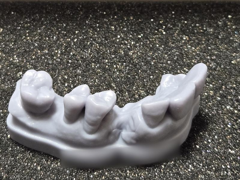 歯を1本失った部分の、3Dプリンターで作った歯の模型